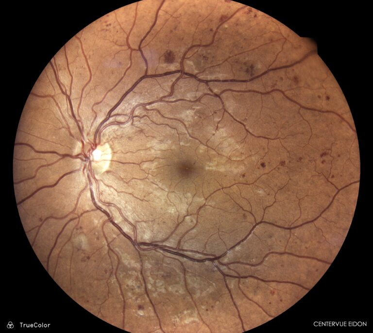 Medical imaging showing diabetic retinopathy.