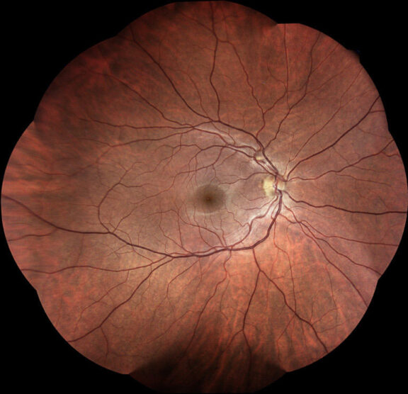 Image of a retina taken with an Eidon Retina camera.
