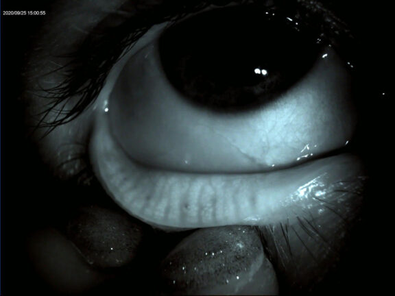 Close up of eye using Meibography.