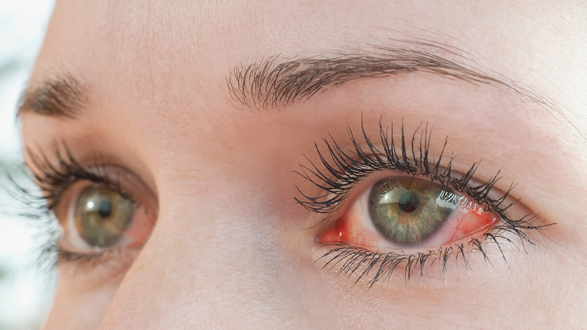 A close-up of a woman with very red, irritated eyes.