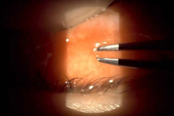 Tweezers preparing to remove an embedded eyelash from under the eyelid.